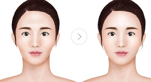 6 Cách khắc phục gò má cao phổ biến nhất hiện nay