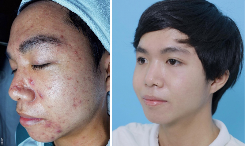 Top 5 sản phẩm Peel da trị thâm mụn tốt nhất hiện nay 2022